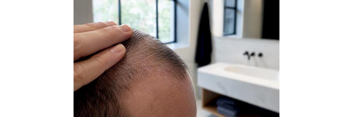Kopfhautprobleme bei Männern: Arten, Ursachen und Lösungen - Kopfhautprobleme bei Männern: Arten, Ursachen und Lösungen